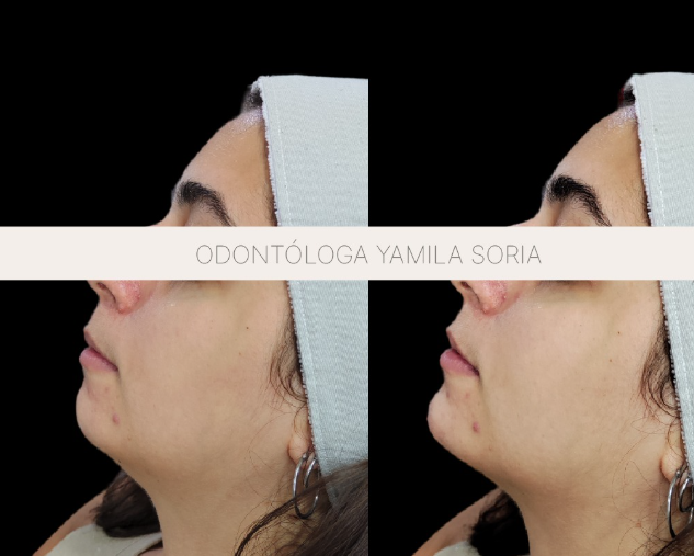 Acido hialuronico frontal